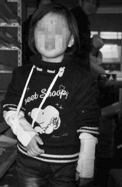 一個（gè）小女孩，雙手裹著繃帶，臉上還有（yǒu）很多血痕（hén）